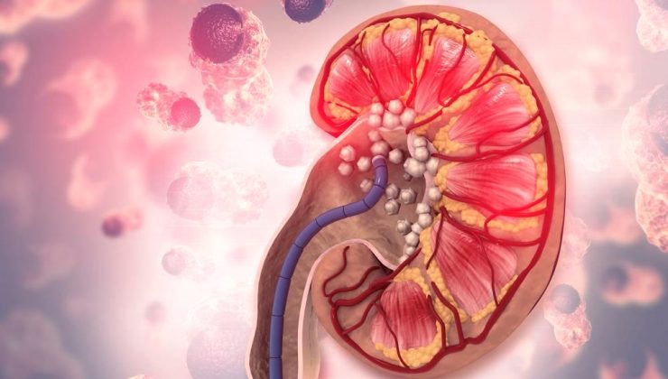 Böbrek Taşı Oluşumunu Azaltmak İçin Doğru Yaşam Tarzı Seçimleri