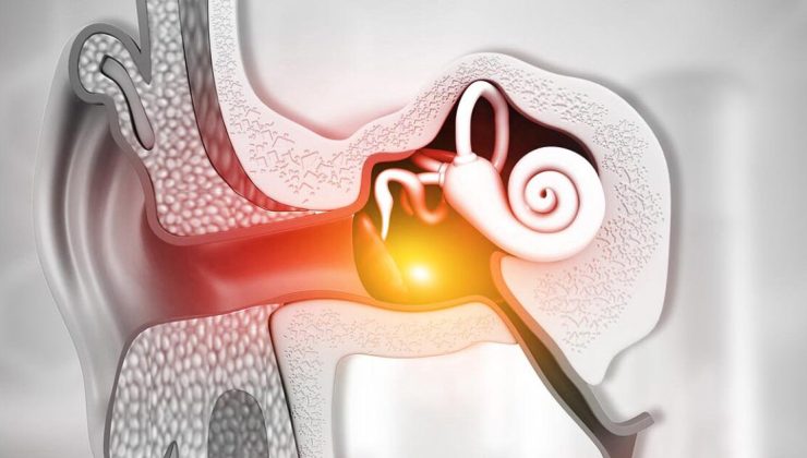 Orta Kulak İltihabı Nedir? Belirtileri, Nedenleri ve Tedavisi