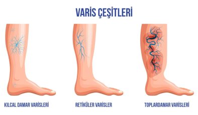 Varis Nedir, neden olur?