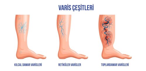 Varis Nedir, neden olur?