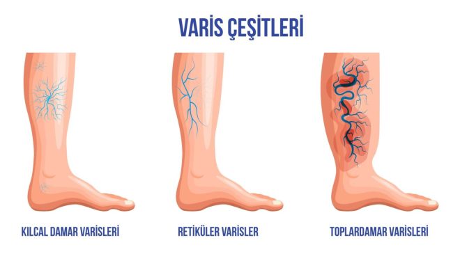 Varis Nedir, neden olur?